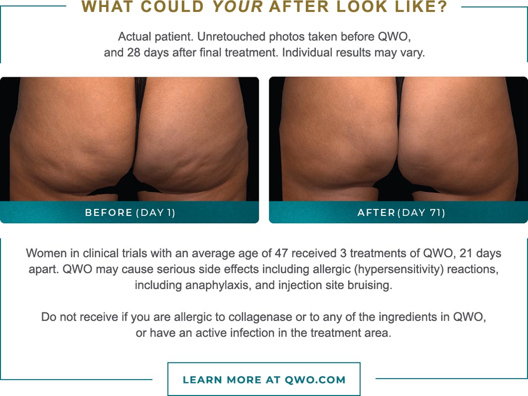 , QWO Cellulite Therapy